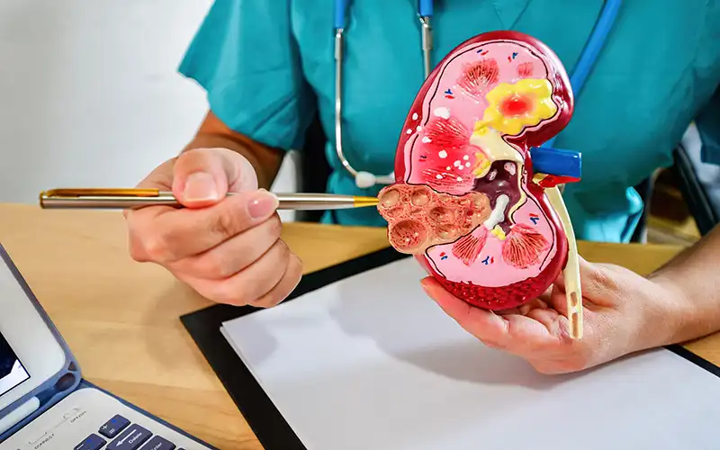 kidney stone analysis